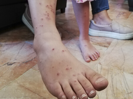 Sso Disminuyen Casos De Varicela